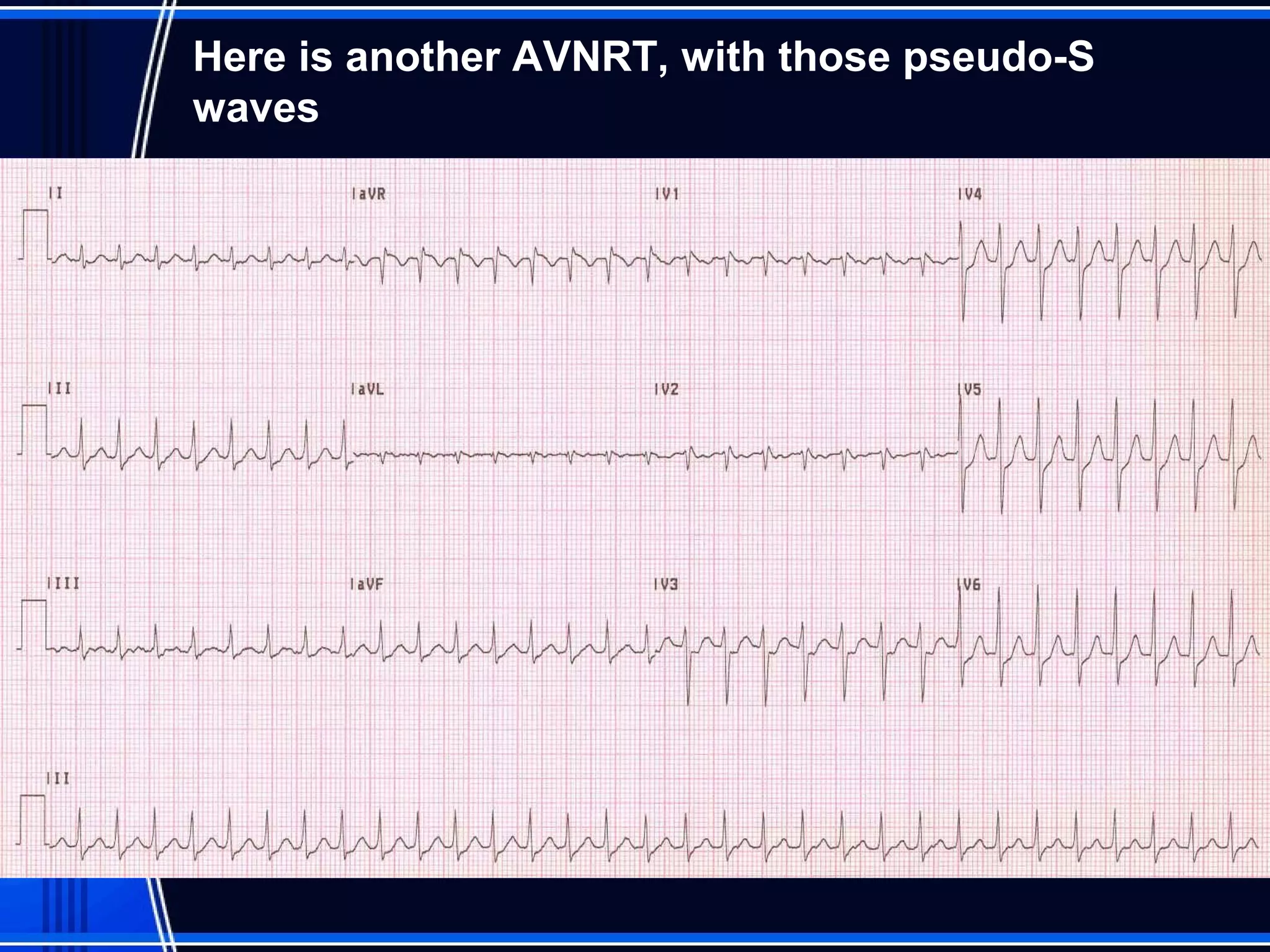 Here is another AVNRT, with those pseudo-S
waves
 