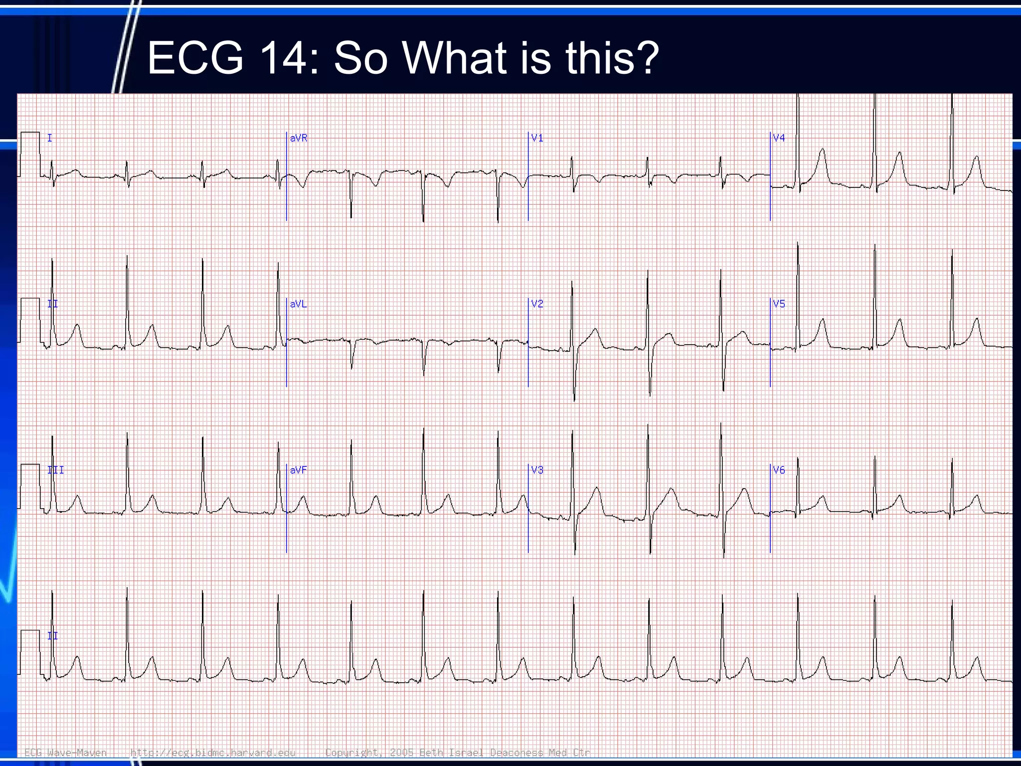 ECG 14: So What is this?
52
 