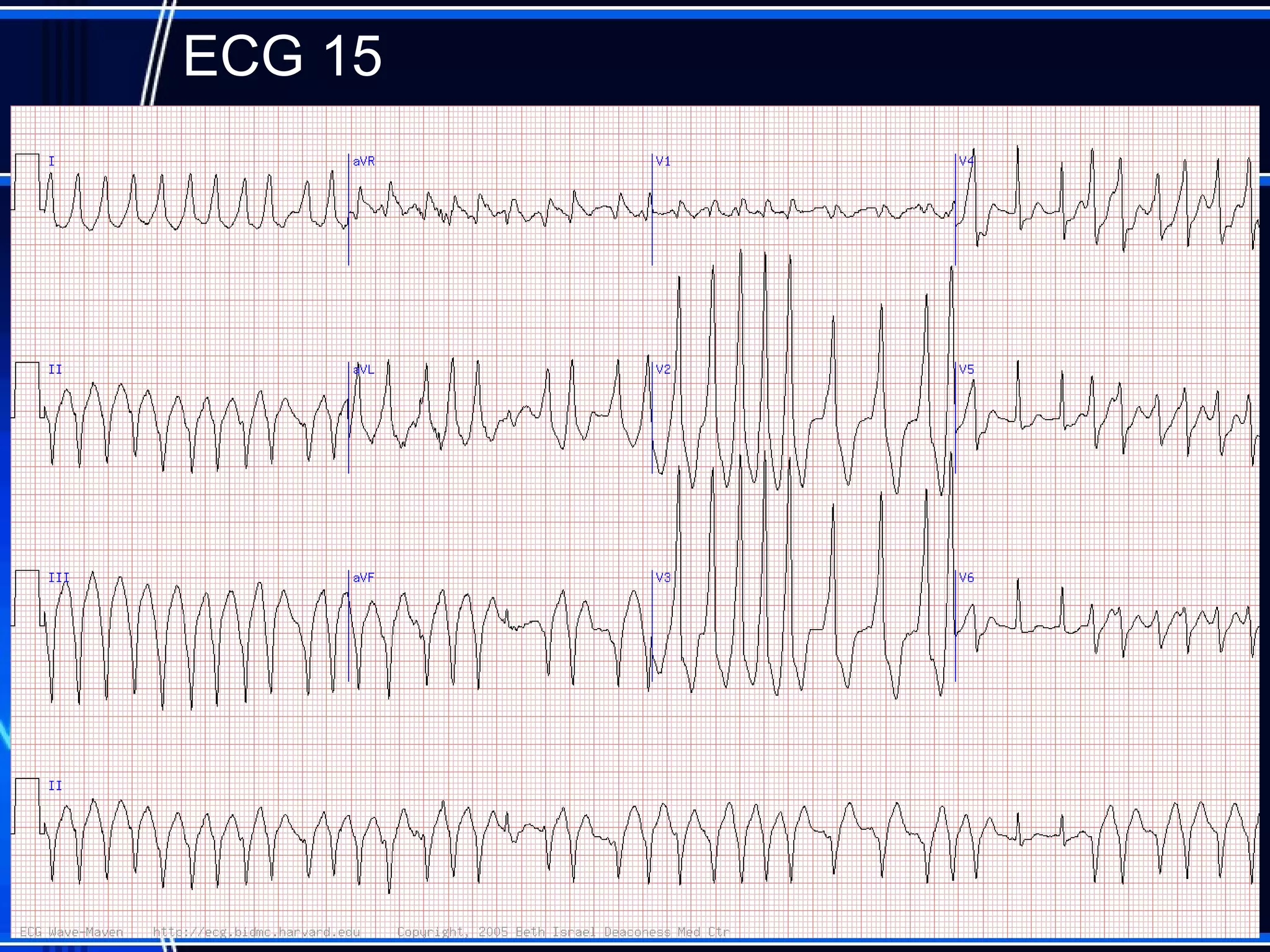 ECG 15
54
 
