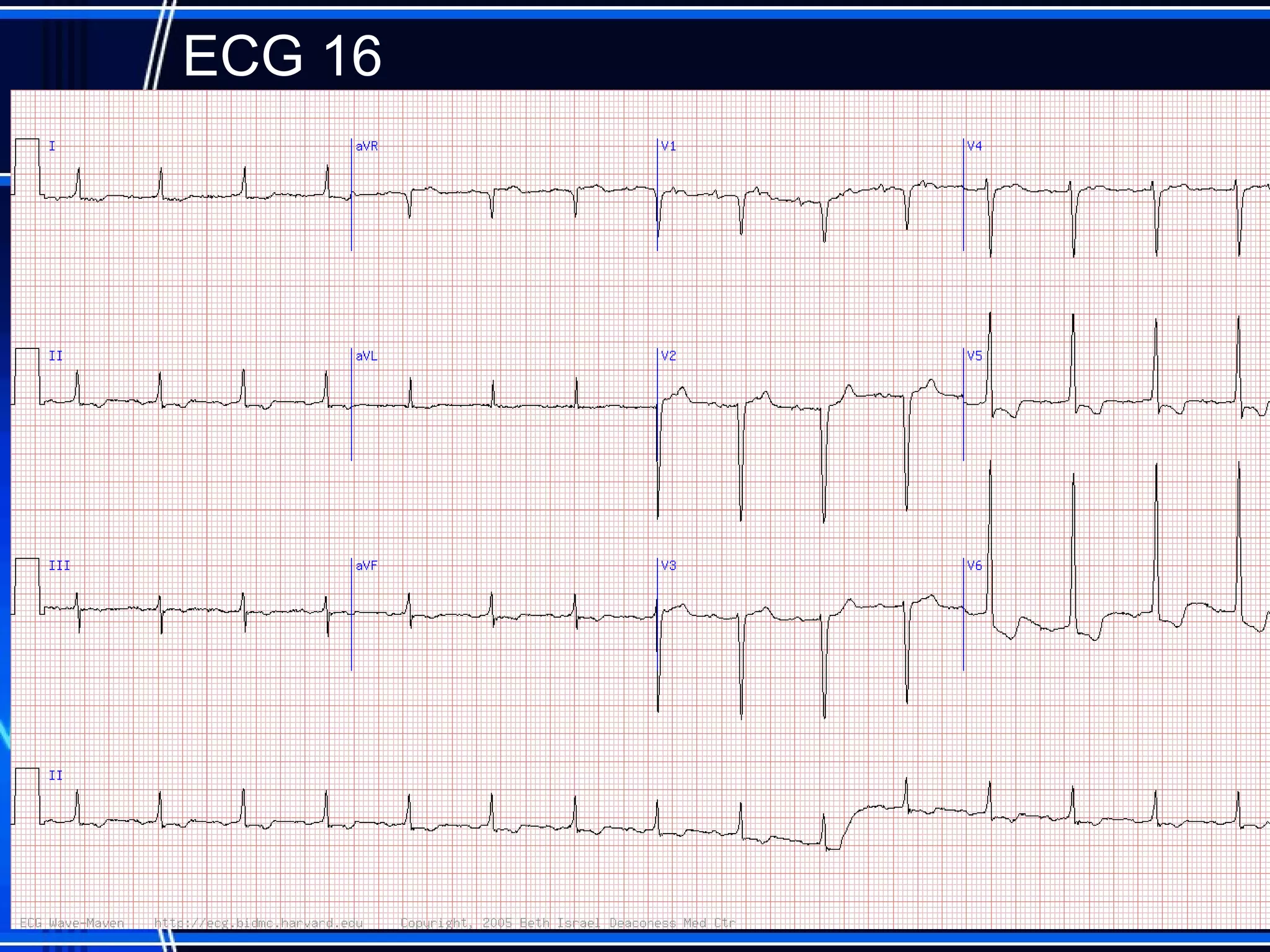 ECG 16
57
 