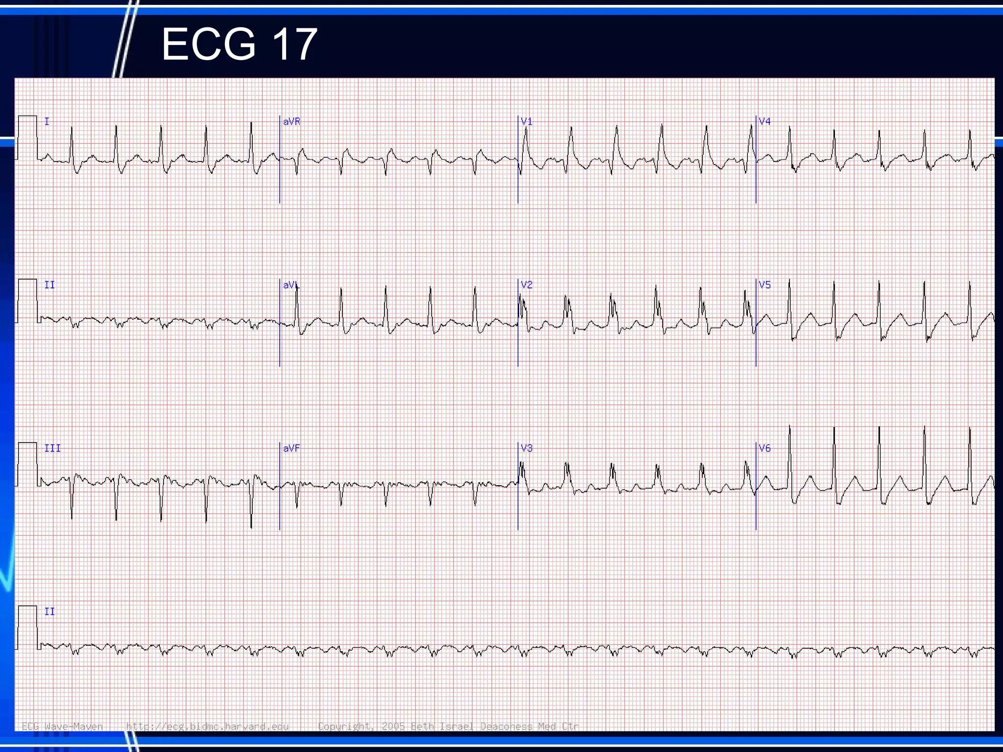 ECG 17
59
 