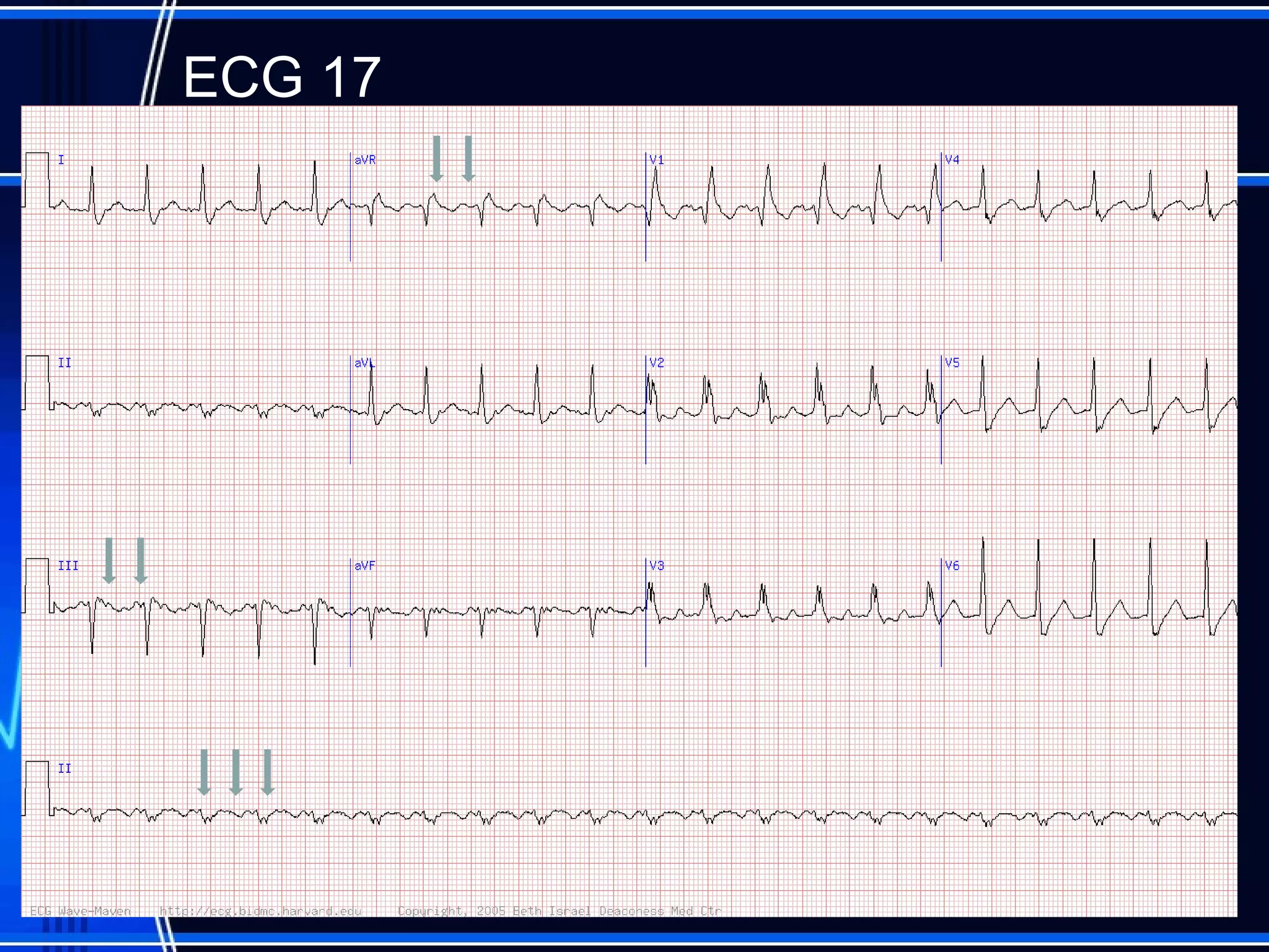 ECG 17
61
 