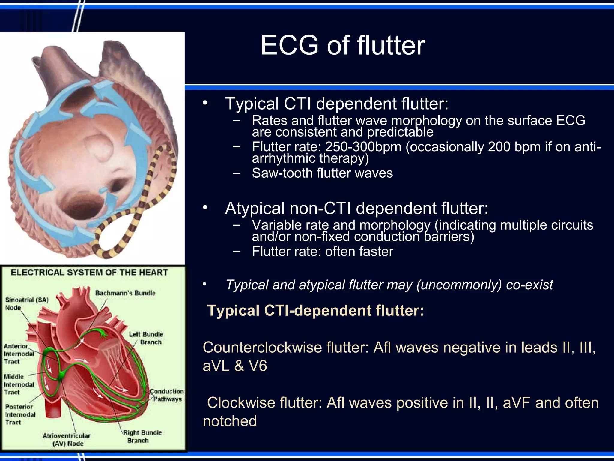 ECG of flutter
• Typical CTI dependent flutter:
– Rates and flutter wave morphology on the surface ECG
are consistent and predictable
– Flutter rate: 250-300bpm (occasionally 200 bpm if on anti-
arrhythmic therapy)
– Saw-tooth flutter waves
• Atypical non-CTI dependent flutter:
– Variable rate and morphology (indicating multiple circuits
and/or non-fixed conduction barriers)
– Flutter rate: often faster
• Typical and atypical flutter may (uncommonly) co-exist
Typical CTI-dependent flutter:
Counterclockwise flutter: Afl waves negative in leads II, III,
aVL & V6
Clockwise flutter: Afl waves positive in II, II, aVF and often
notched
 