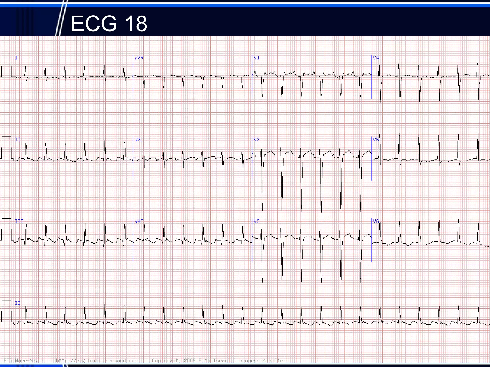 ECG 18
65
 