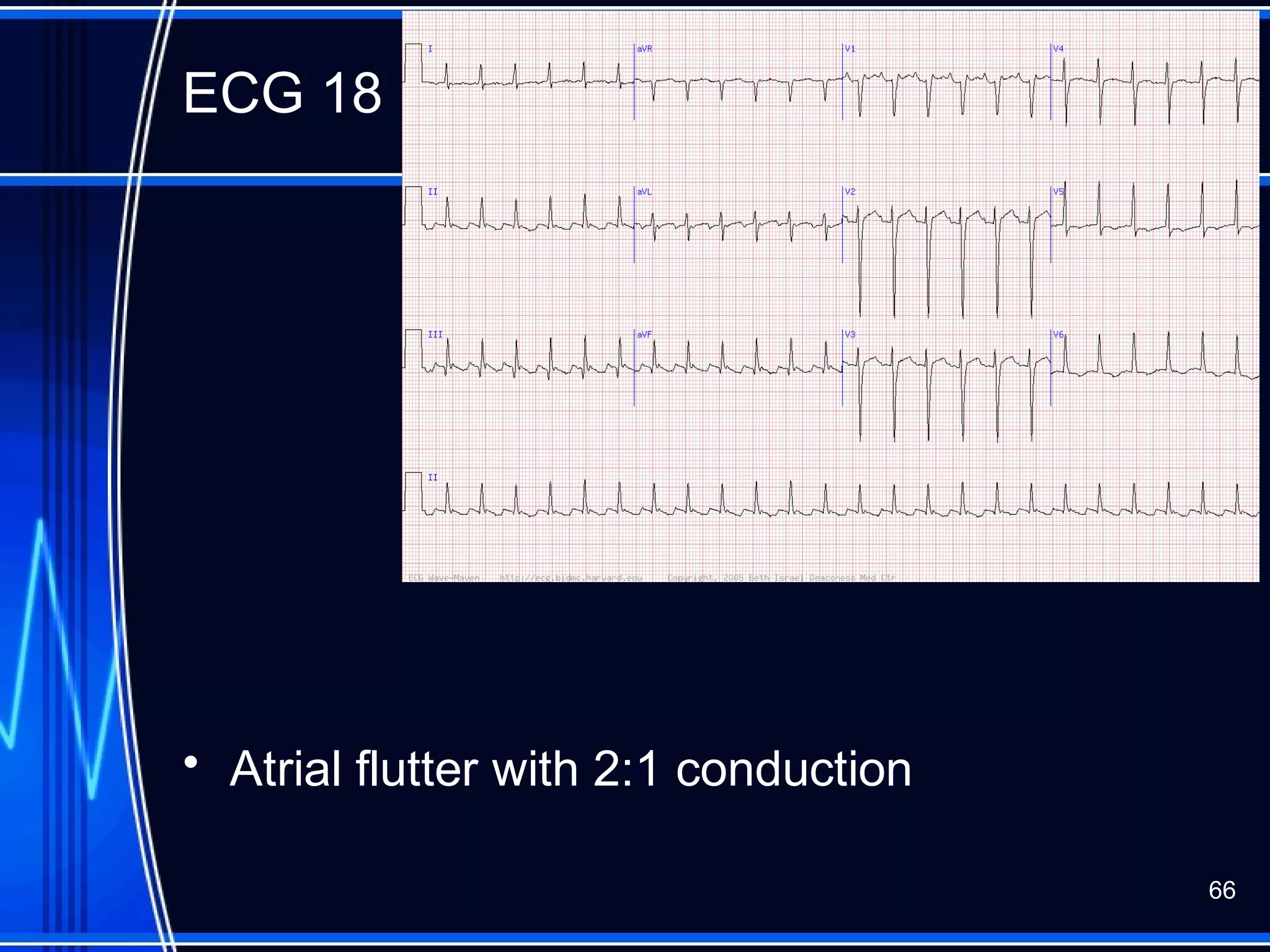 ECG 18
• Atrial flutter with 2:1 conduction
66
 