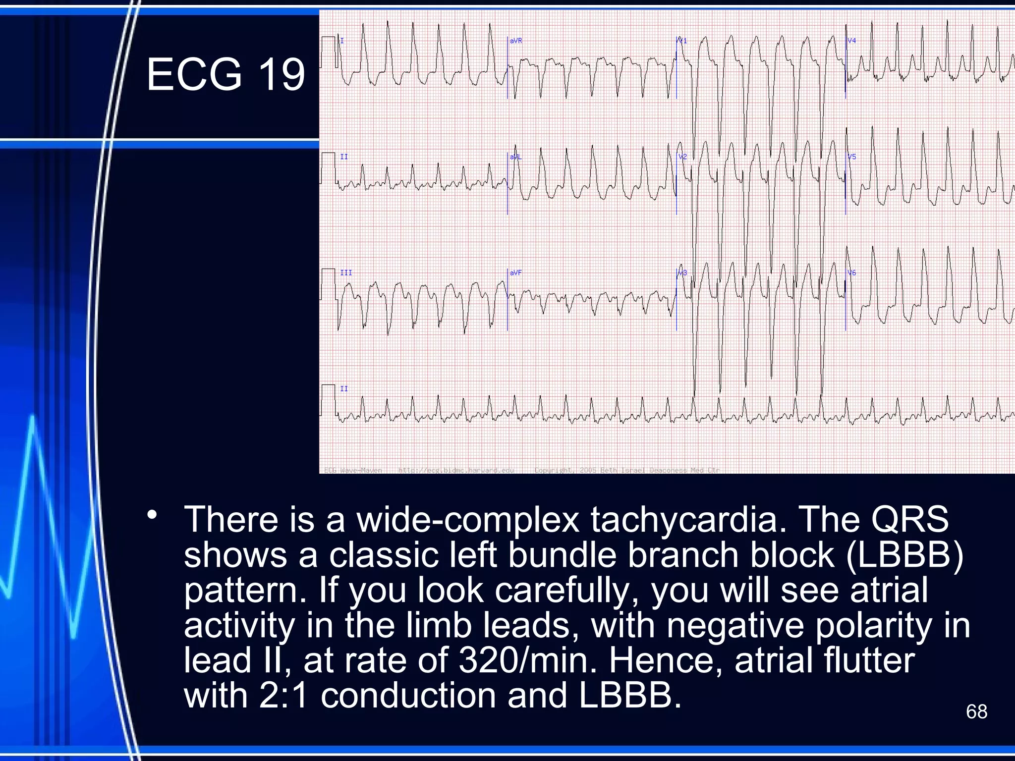 ECG 19
• There is a wide-complex tachycardia. The QRS
shows a classic left bundle branch block (LBBB)
pattern. If you look carefully, you will see atrial
activity in the limb leads, with negative polarity in
lead II, at rate of 320/min. Hence, atrial flutter
with 2:1 conduction and LBBB. 68
 