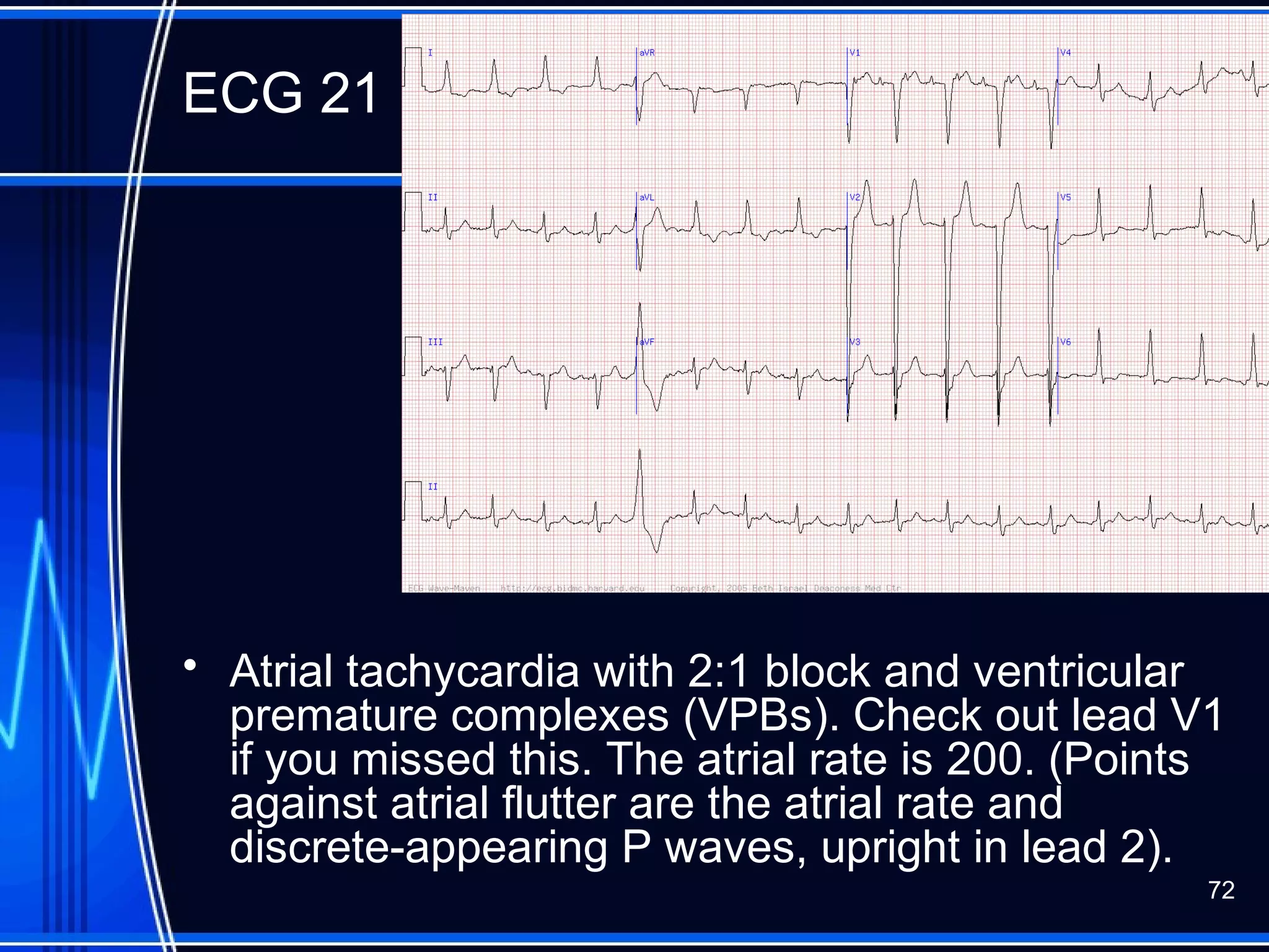 ECG 21
• Atrial tachycardia with 2:1 block and ventricular
premature complexes (VPBs). Check out lead V1
if you missed this. The atrial rate is 200. (Points
against atrial flutter are the atrial rate and
discrete-appearing P waves, upright in lead 2).
72
 