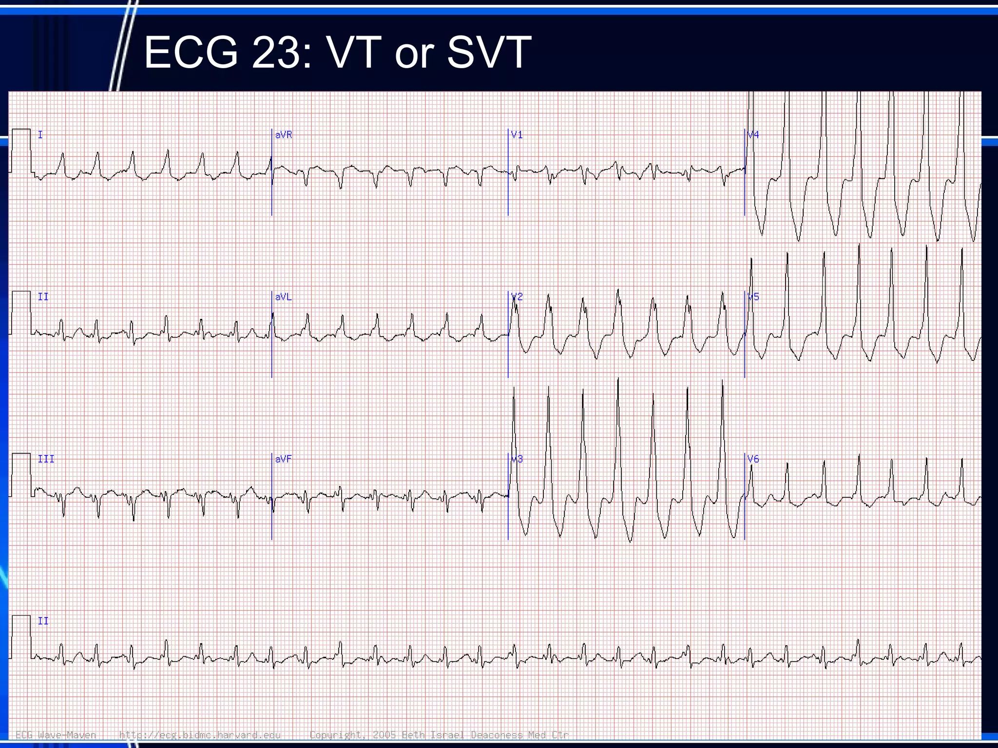 ECG 23: VT or SVT
82
 