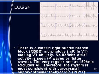 ECG approach to arrhythmias 2017 | PPT