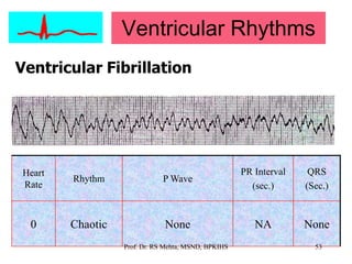 Normal Vf Ecg & arrhythmias | PPSX