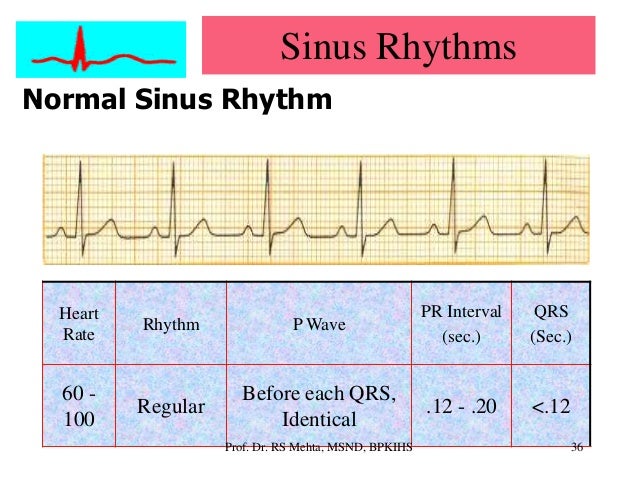 Ecg Arrhythmias Ecg Arrhythmias