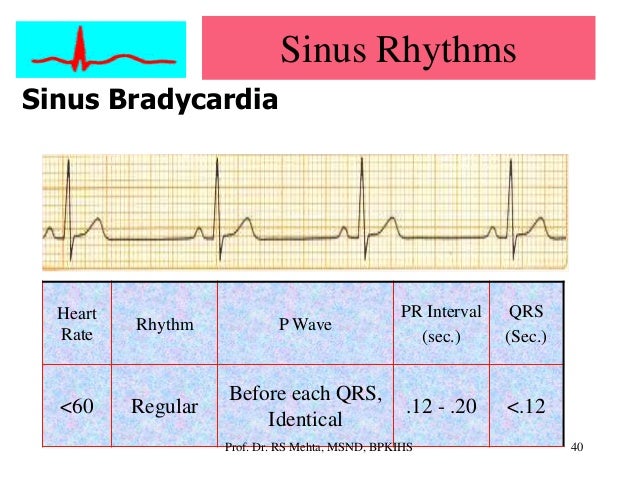 Ecg Arrhythmias
