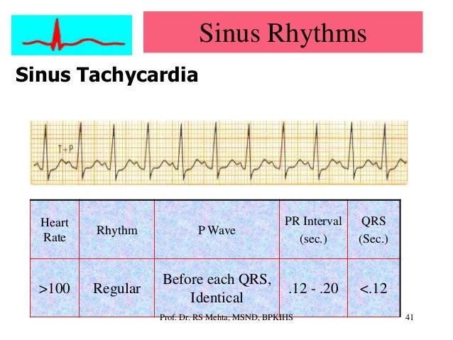 Ecg Arrhythmias