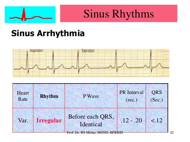 Ecg Arrhythmias Ecg Arrhythmias