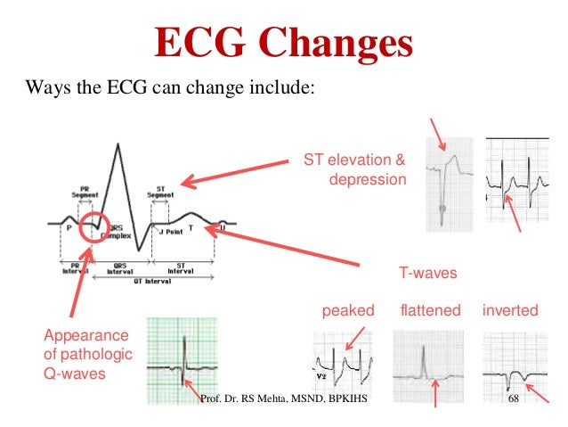Ecg Arrhythmias