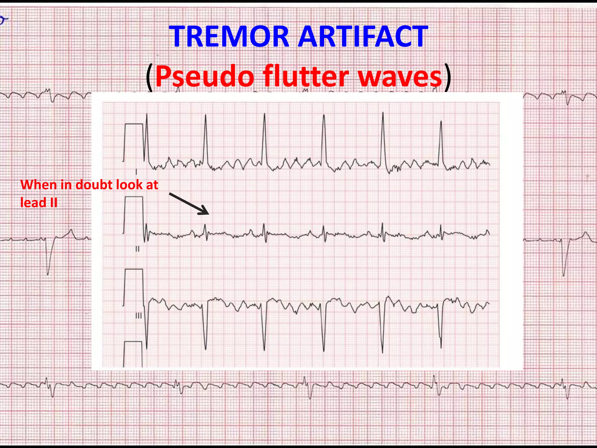 Somatic Tremor Artifact Is Commonly Caused By