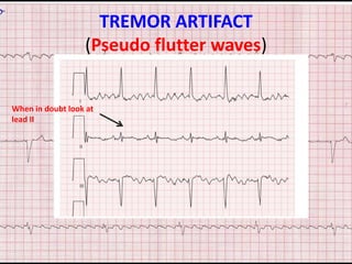 ECG ARTIFACTS AND PITFALLS | PPT