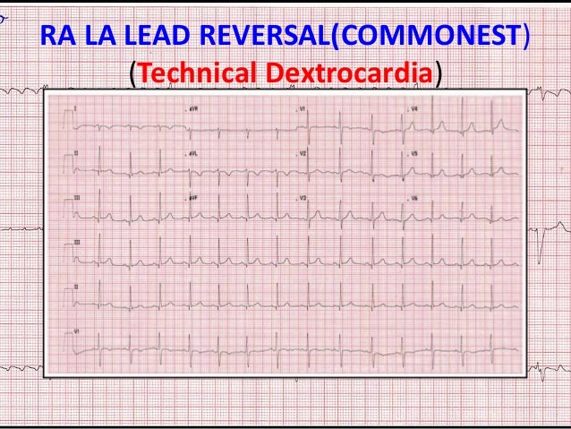 Ecg Artifacts And Pitfalls Ecg Artifacts And Pitfalls