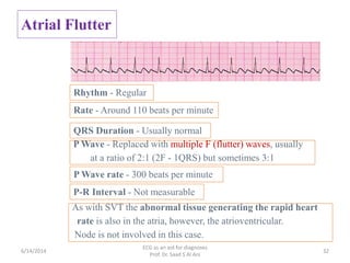 Ecg as an aid for diagnoses | PPTX