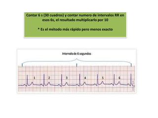 Contar 6 s (30 cuadros) y contar numero de intervalos RR en
esos 6s, el resultado multiplicarlo por 10
* Es el método más rápido pero menos exacto
 