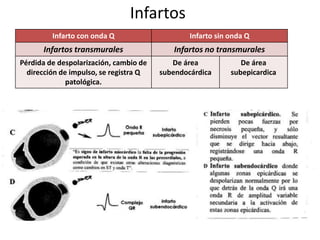 Infartos
Infarto con onda Q Infarto sin onda Q
Infartos transmurales Infartos no transmurales
Pérdida de despolarización, cambio de
dirección de impulso, se registra Q
patológica.
De área
subendocárdica
De área
subepicardica
 