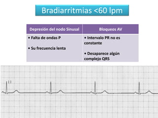 Bradiarritmias <60 lpm
Depresión del nodo Sinusal Bloqueos AV
• Falta de ondas P
• Su frecuencia lenta
• Intervalo PR no es
constante
• Desaparece algún
complejo QRS
 