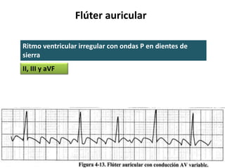 Flúter auricular
Ritmo ventricular irregular con ondas P en dientes de
sierra
II, III y aVF
 