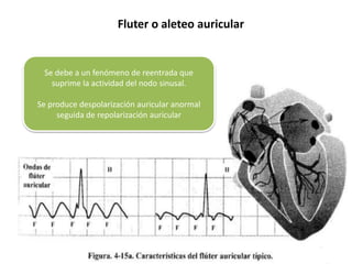Se debe a un fenómeno de reentrada que
suprime la actividad del nodo sinusal.
Se produce despolarización auricular anormal
seguida de repolarización auricular
Fluter o aleteo auricular
 
