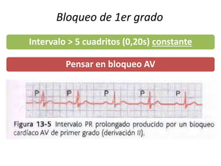 Bloqueo de 1er grado
Pensar en bloqueo AV
Intervalo > 5 cuadritos (0,20s) constante
 