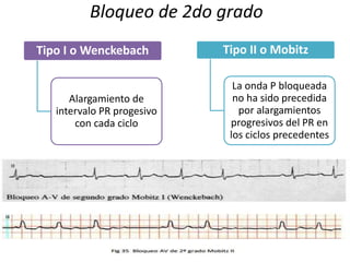 Bloqueo de 2do grado
Tipo I o Wenckebach
Alargamiento de
intervalo PR progesivo
con cada ciclo
Tipo II o Mobitz
La onda P bloqueada
no ha sido precedida
por alargamientos
progresivos del PR en
los ciclos precedentes
 