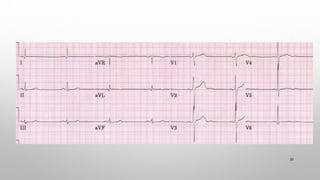 Positive Exercise Ecg Example Comprehensive ECG Practice Exercises by Dr. Trần Công Đoàn | PDF