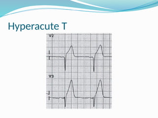 D R Sobuj ECG Basic.pptx, Dr. M.A. Sobuj Hayat, MBBS, BCS, D-Card(BSMMU) | PPTX