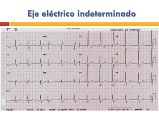 Eje eléctrico indeterminado
 