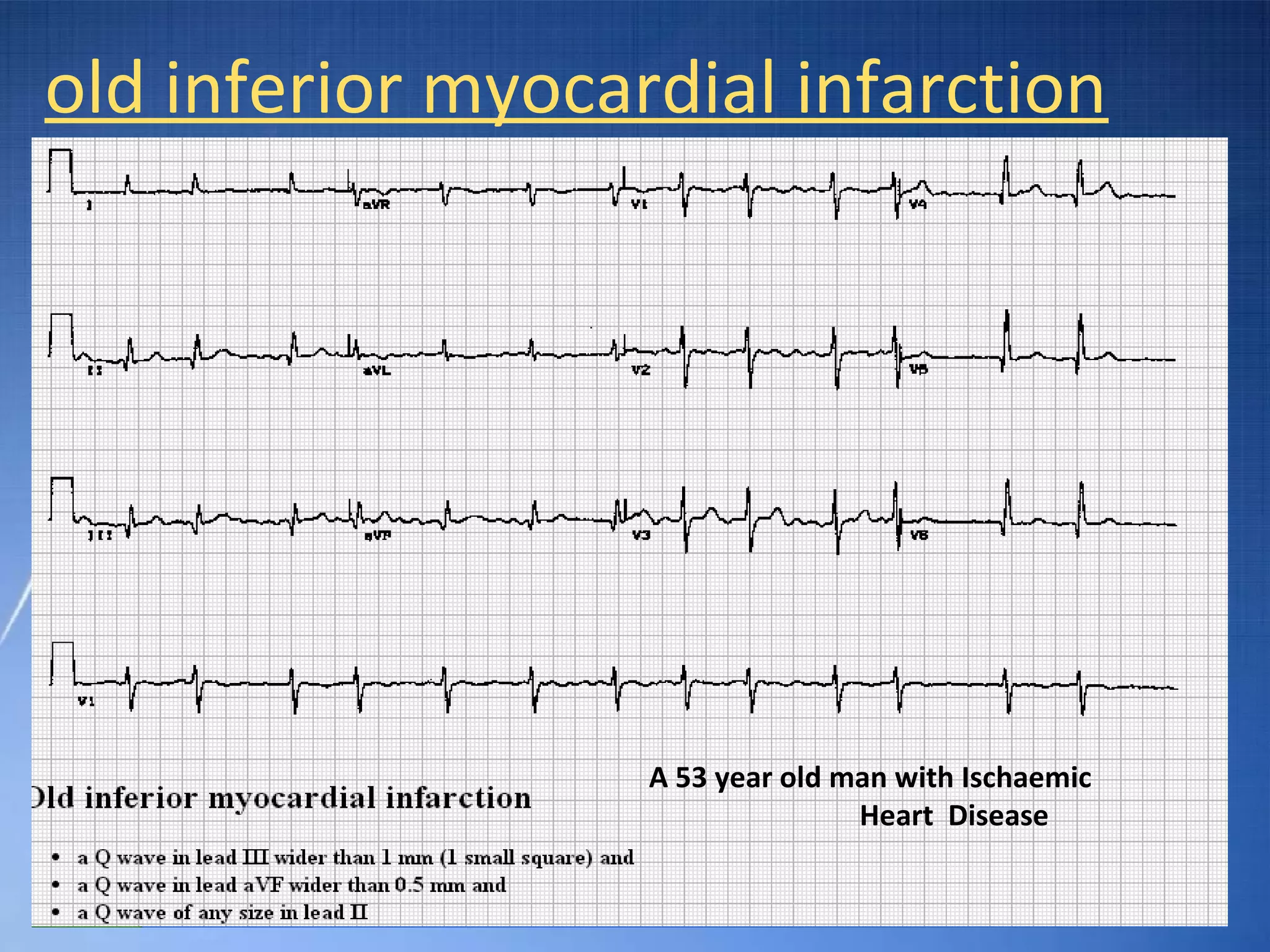 Ecg Basic Guidelines PPT