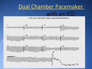 Ecg basic guidelines | PPT