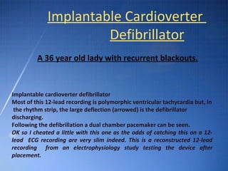 Ecg basic guidelines | PPT