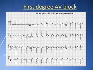 Ecg basic guidelines | PPT