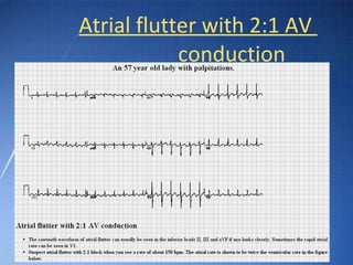 Ecg basic guidelines | PPT