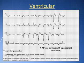 Vvt Pacemaker Ecg basic guidelines | PPT