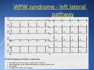 Wpw High Risk Pathway Algorithm Ecg basic guidelines | PPT