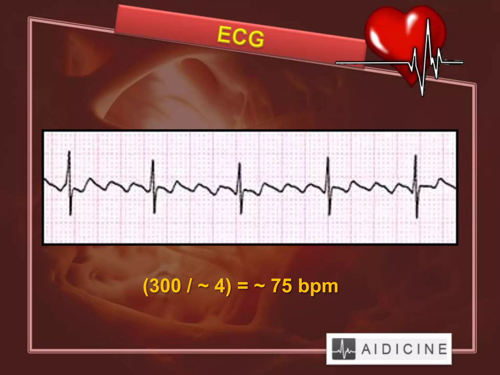 (300 / ~ 4) = ~ 75 bpm
 