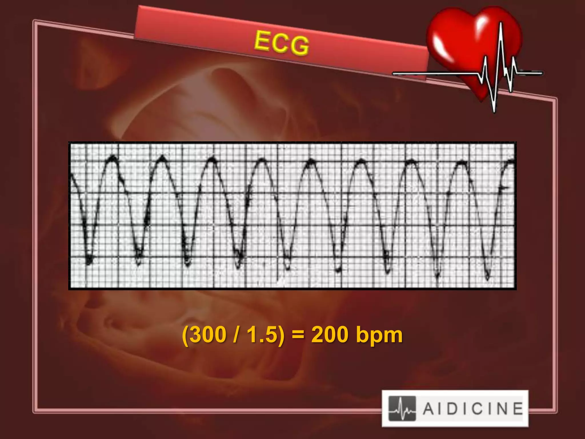 (300 / 1.5) = 200 bpm
 