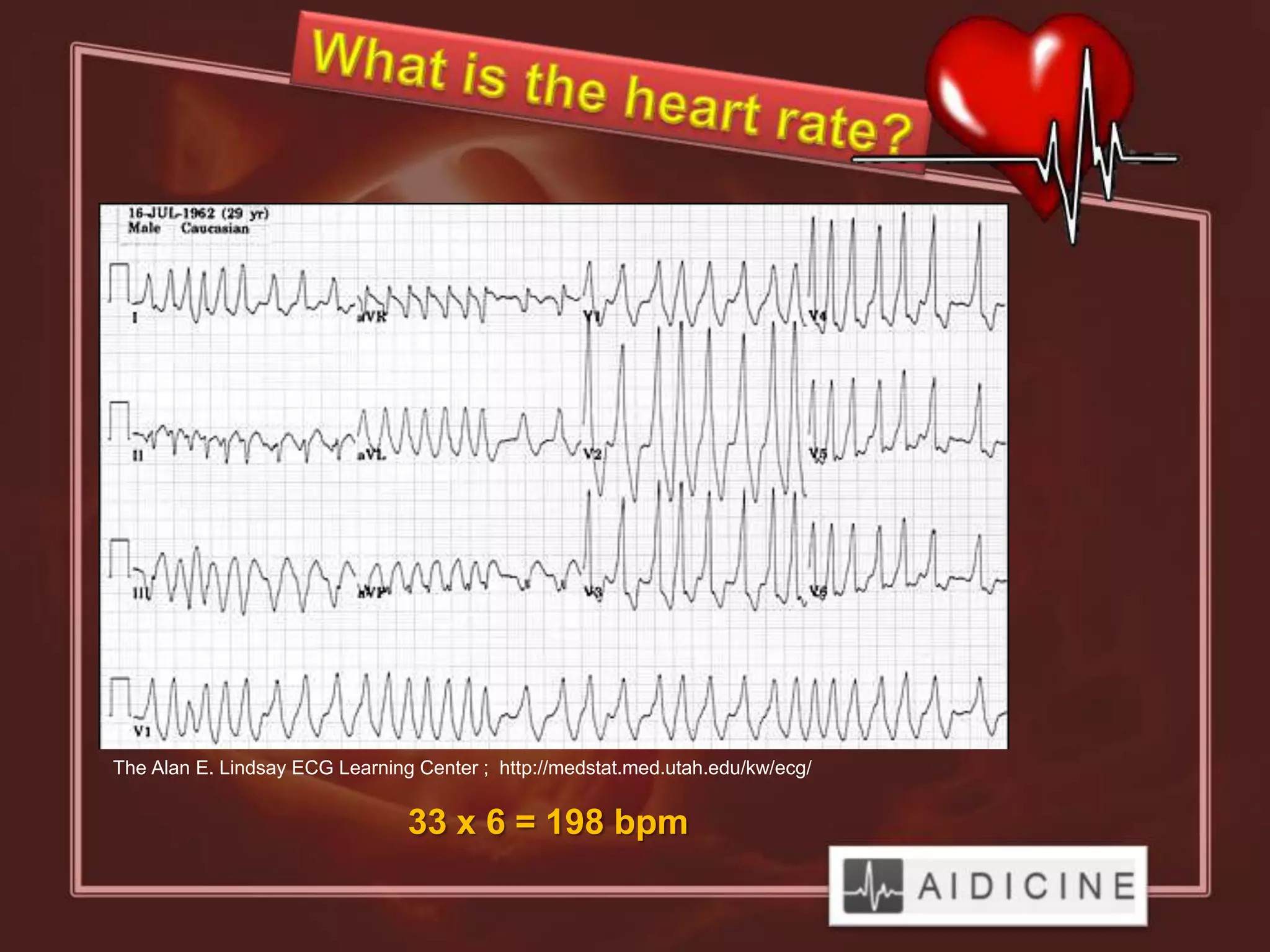 The Alan E. Lindsay ECG Learning Center ; http://medstat.med.utah.edu/kw/ecg/


                                33 x 6 = 198 bpm
 