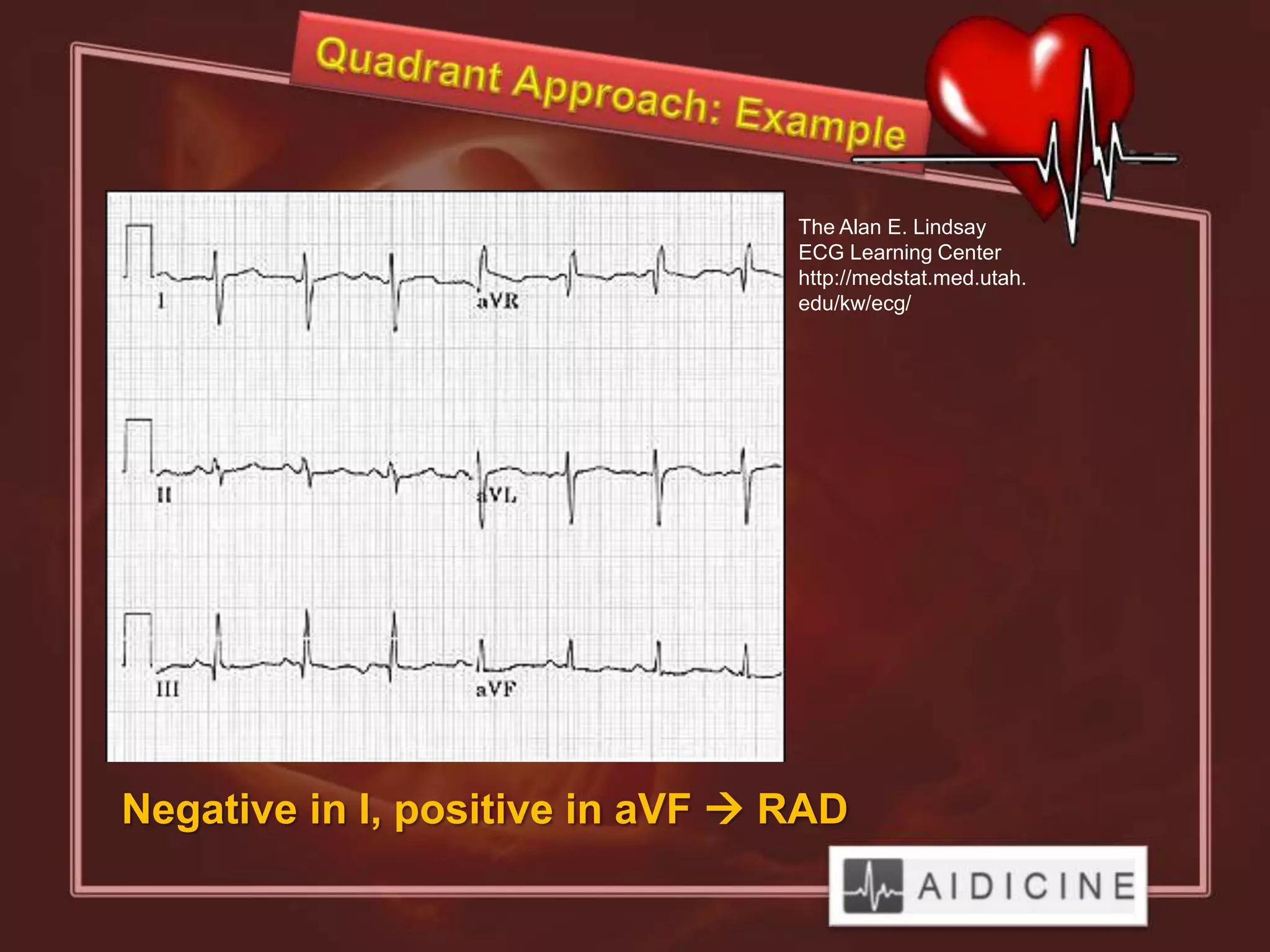 The Alan E. Lindsay
                                 ECG Learning Center
                                 http://medstat.med.utah.
                                 edu/kw/ecg/




Negative in I, positive in aVF  RAD
 