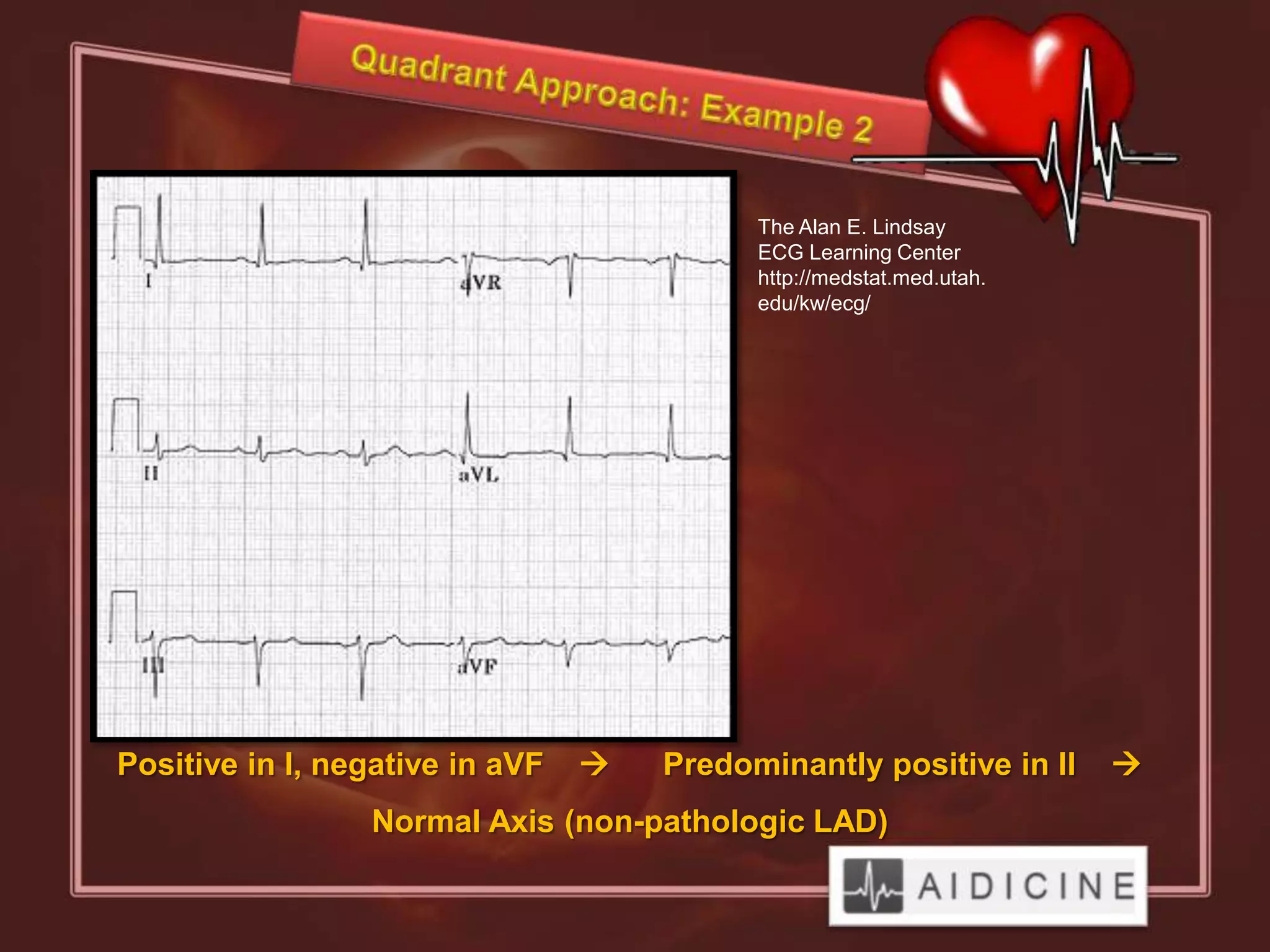 The Alan E. Lindsay
                                           ECG Learning Center
                                           http://medstat.med.utah.
                                           edu/kw/ecg/




Positive in I, negative in aVF      Predominantly positive in II     
                 Normal Axis (non-pathologic LAD)
 