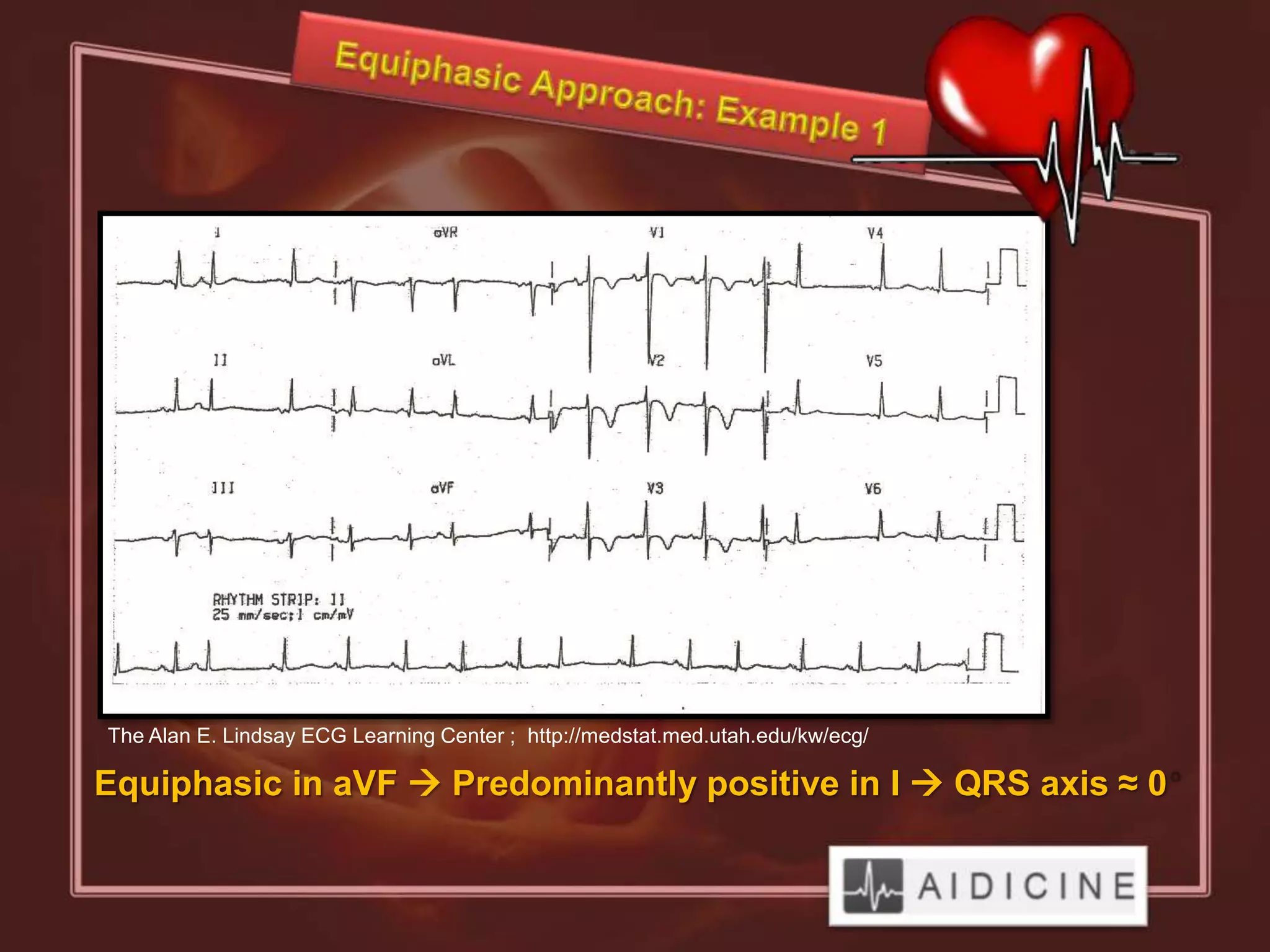 The Alan E. Lindsay ECG Learning Center ; http://medstat.med.utah.edu/kw/ecg/

Equiphasic in aVF  Predominantly positive in I  QRS axis ≈ 0
 