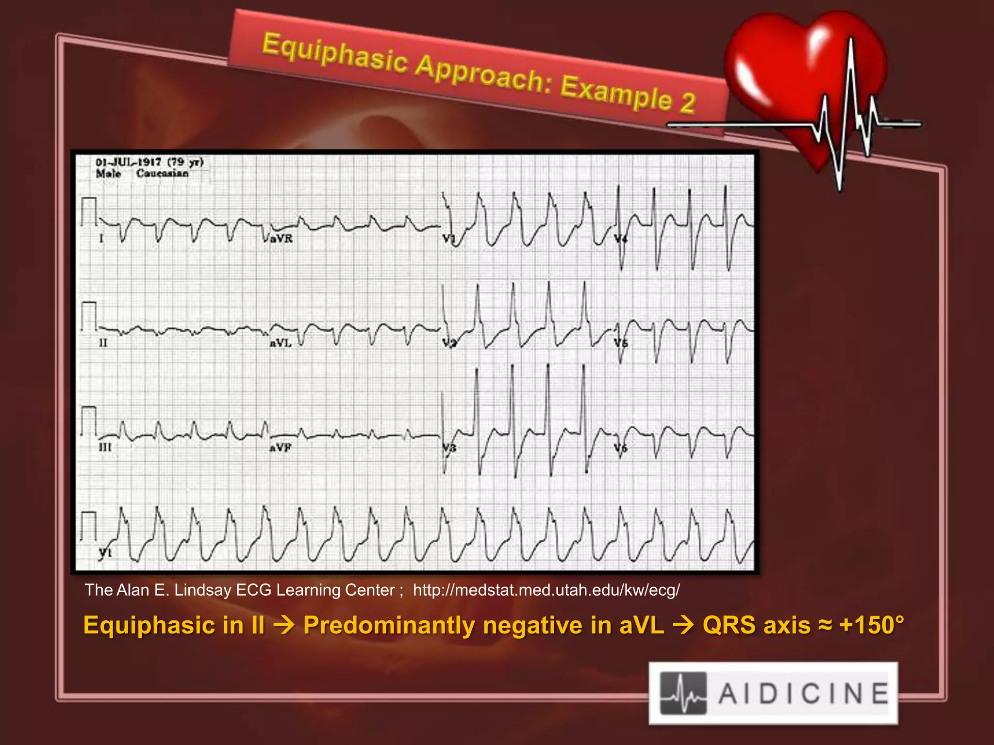 The Alan E. Lindsay ECG Learning Center ; http://medstat.med.utah.edu/kw/ecg/

Equiphasic in II  Predominantly negative in aVL  QRS axis ≈ +150°
 