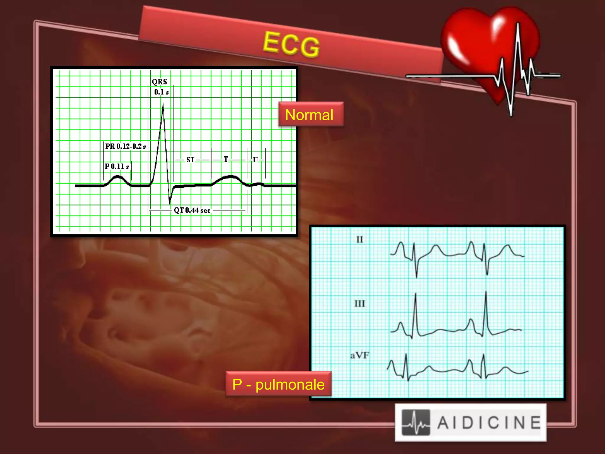 Normal




P - pulmonale
 