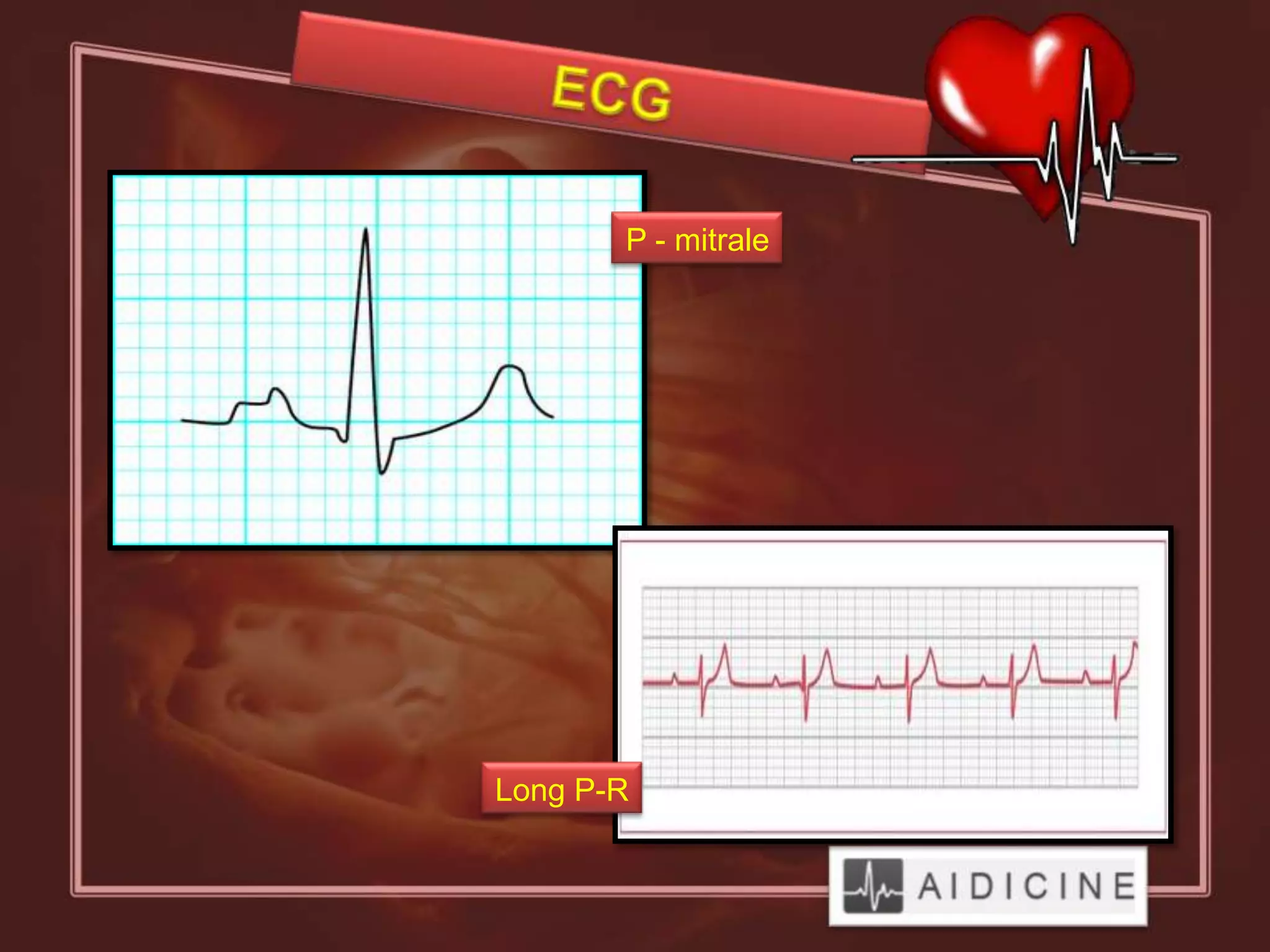 P - mitrale




Long P-R
 