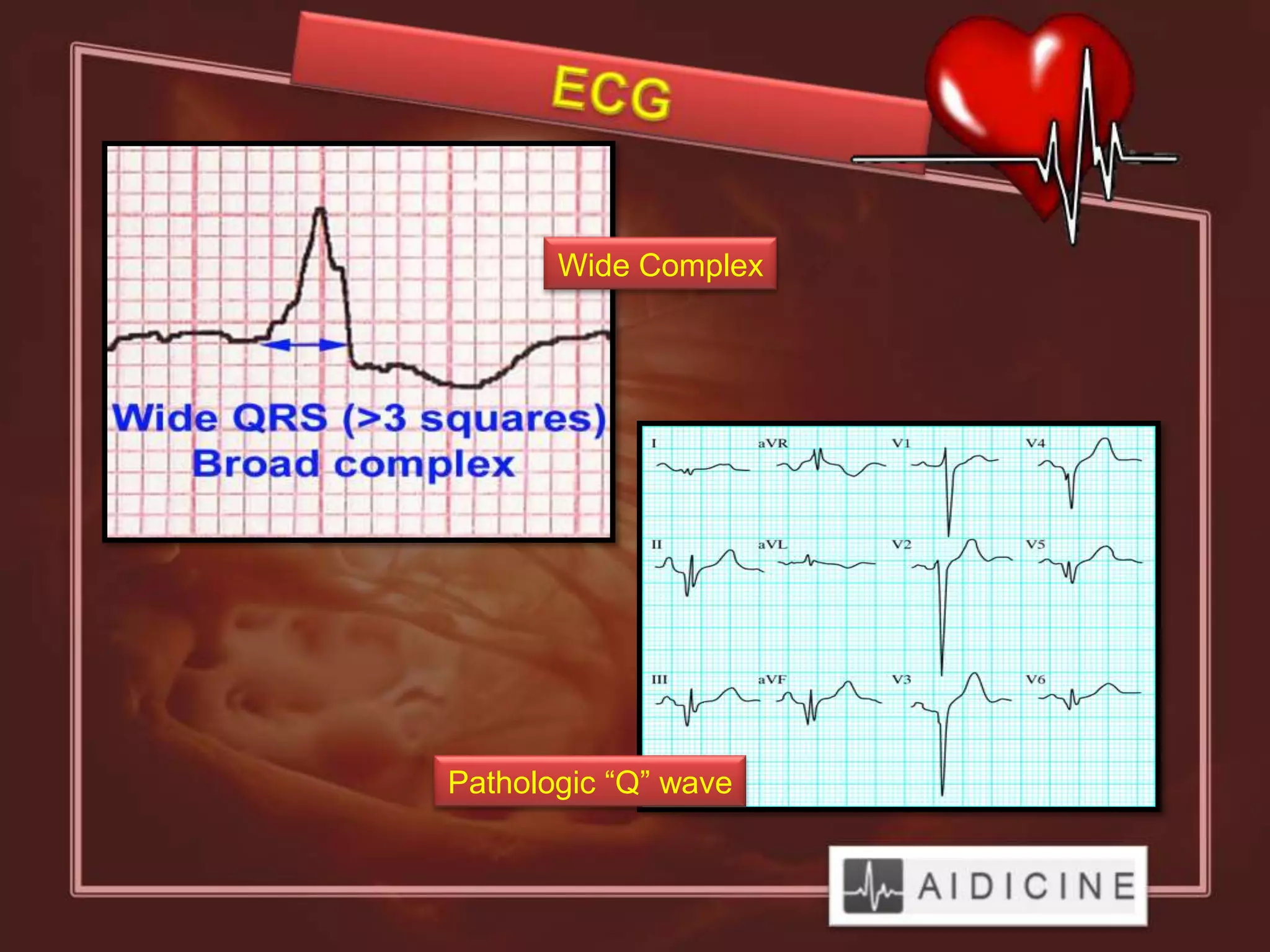 Wide Complex




Pathologic “Q” wave
 